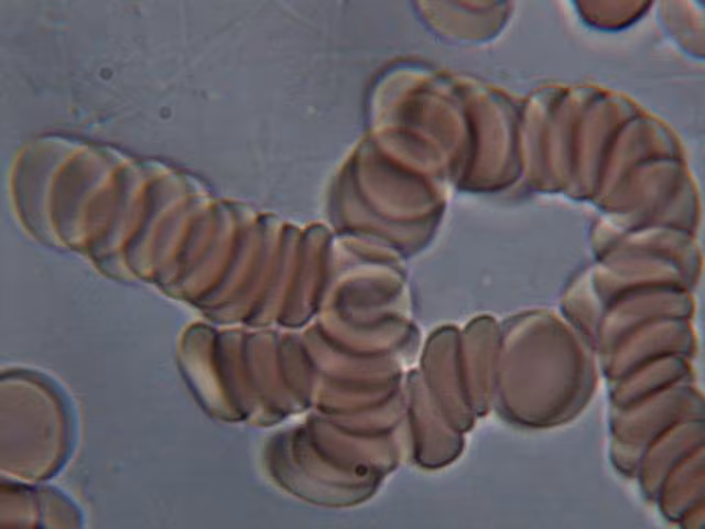 Medicina natural para la hipertensión o presión arterial alta